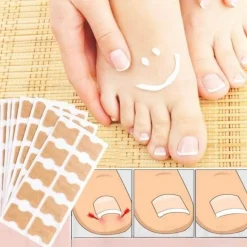 Aufkleber zur Korrektur eingewachsener Zehennägel – Behandlung der Zehenausrichtung