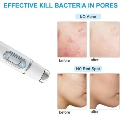 Laser-Hautstraffungsgerät - Ultraschall-Gesichtsbehandlungsgerät